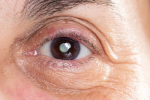Cataract Surgery Vs. Laser Eye Surgery symptoms