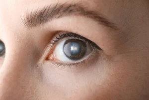 central retinal vein occlusion